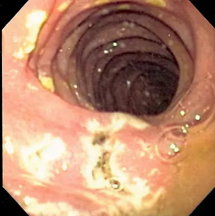 La carte Syndrome de Zollinger-Ellison