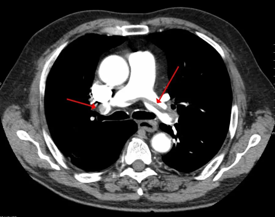 The Pulmonary embolism card