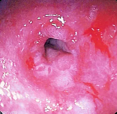 La carte Reflux gastro-œsophagien