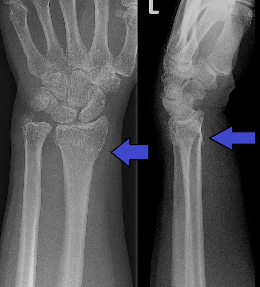 The Colles' fracture card