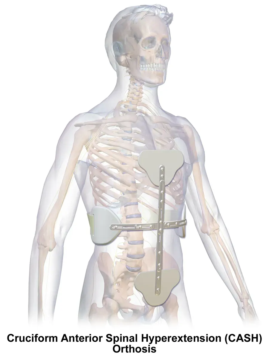 The Myelopathy card