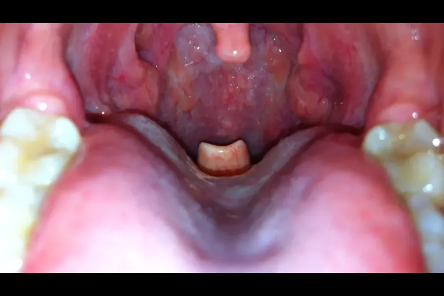 The Epiglottis card