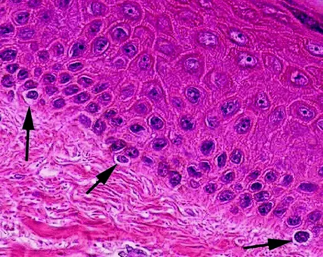 The Melanocyte card