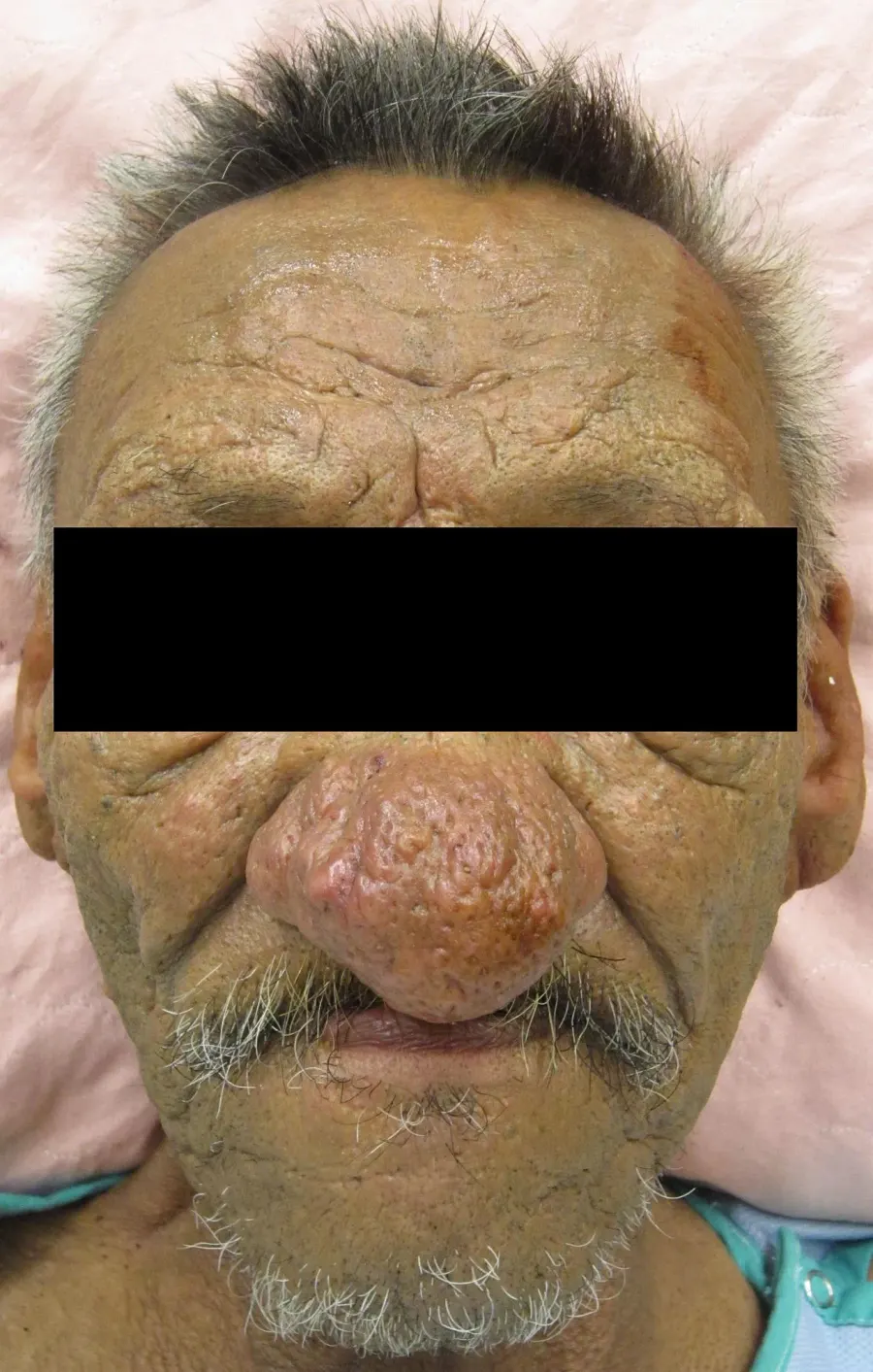 La carte Rhinophyma