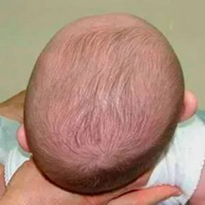 The Plagiocephaly card