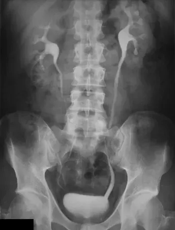 La carte Urographie intraveineuse