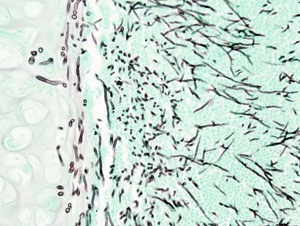 The Aspergillosis card