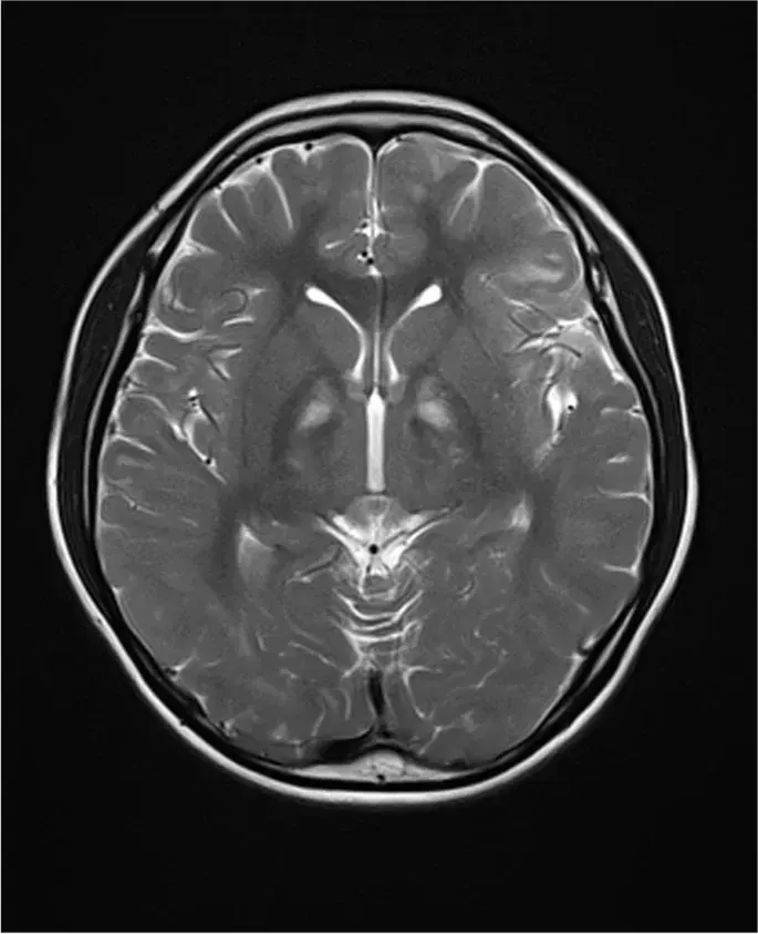 The Kearns–Sayre syndrome card