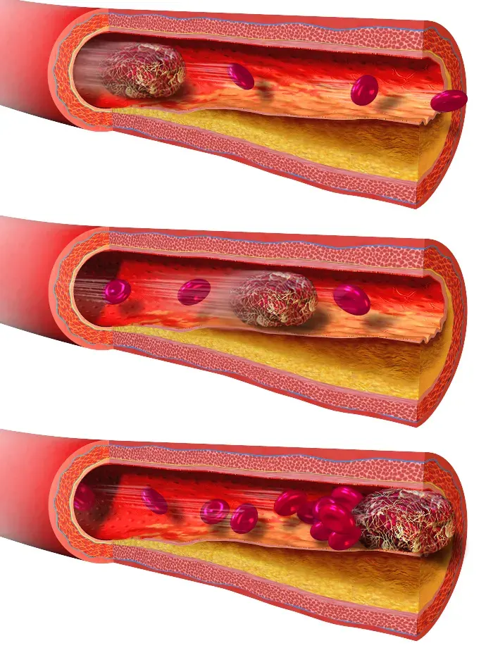 La carte Thrombose