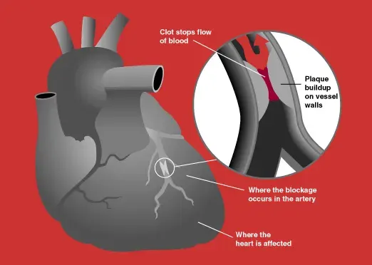 The Acute coronary syndrome card