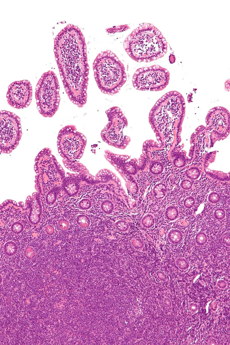 The Mantle cell lymphoma card