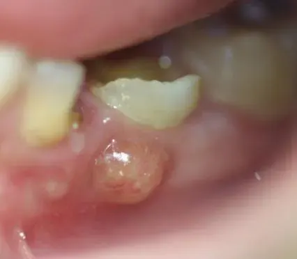 The Dental abscess card