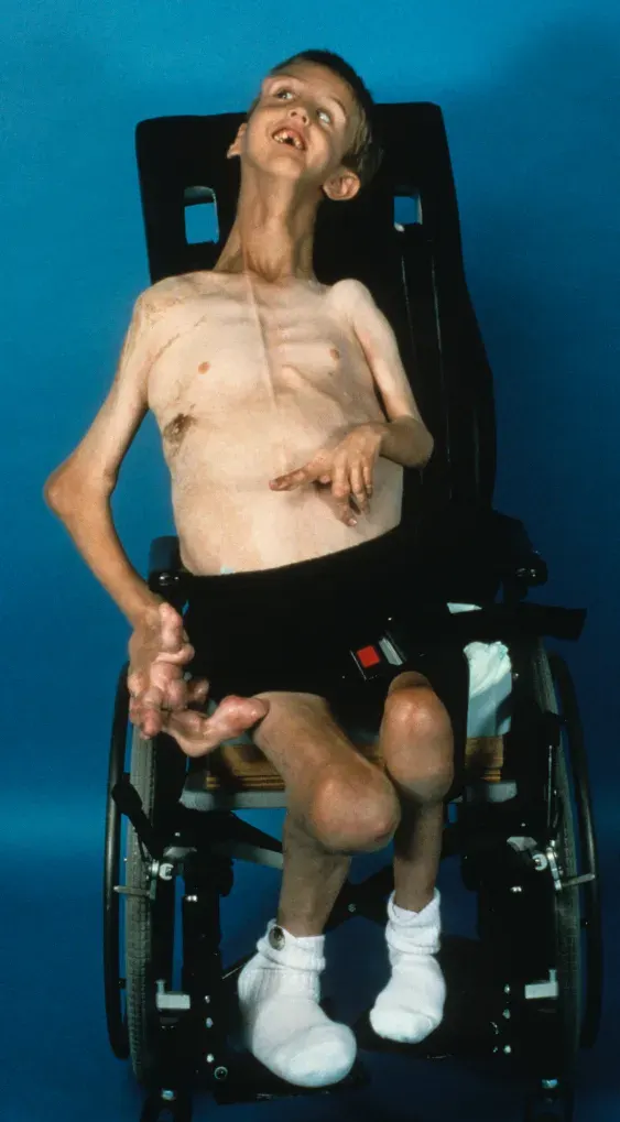 The Proteus syndrome card