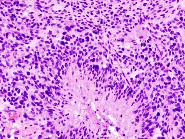 The Glioblastoma card