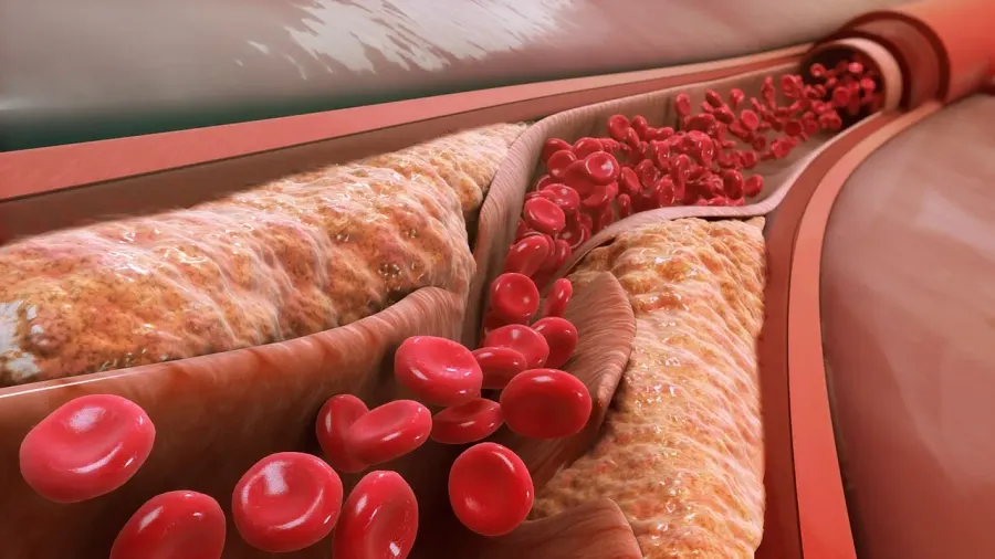 The Low-density lipoprotein card