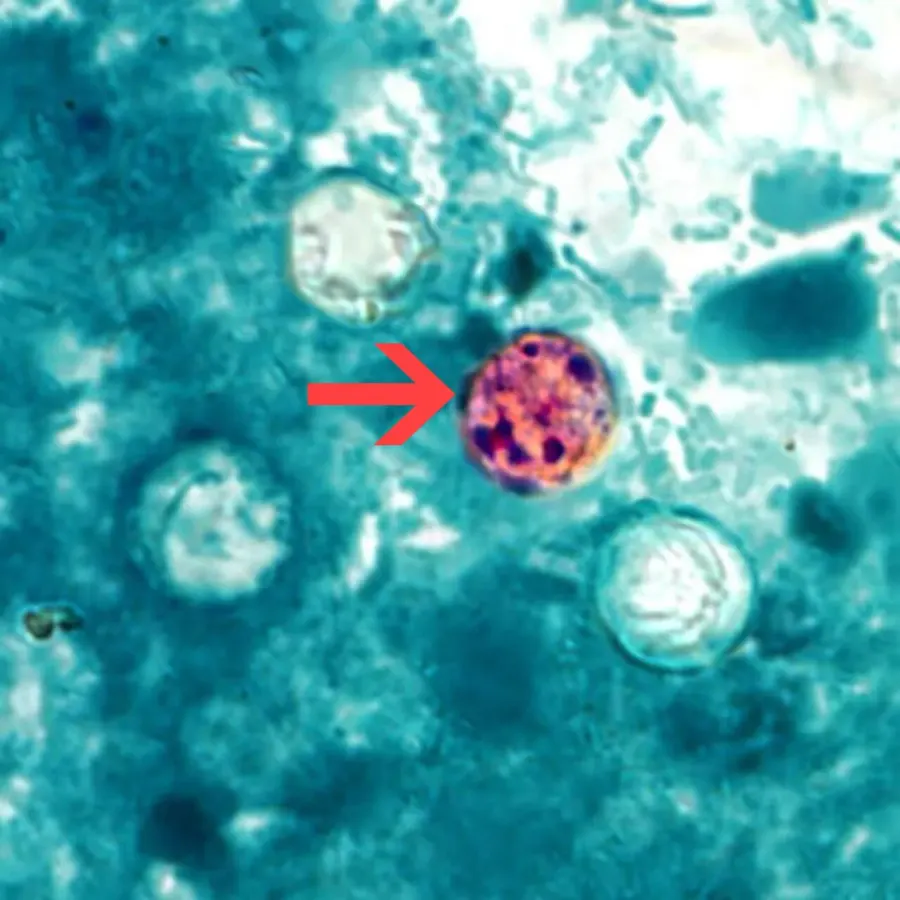 The Cyclosporiasis card