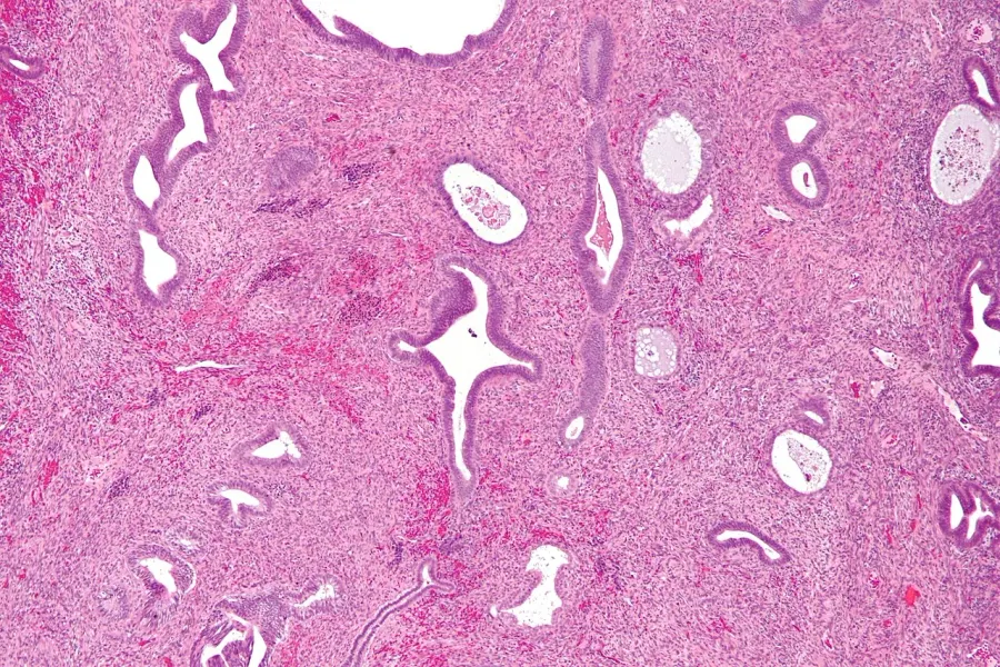 La carte Polype endométrial