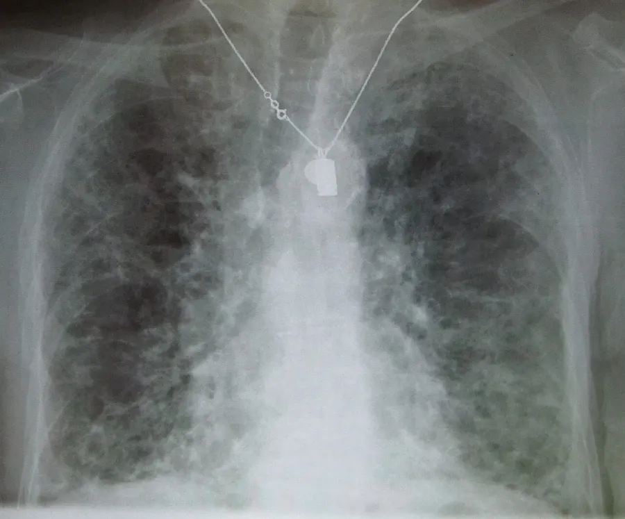 The Pulmonary fibrosis card