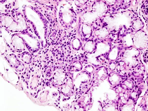 The Sjögren's disease card