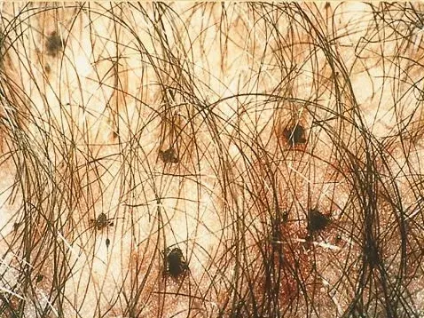 The Pediculosis pubis card