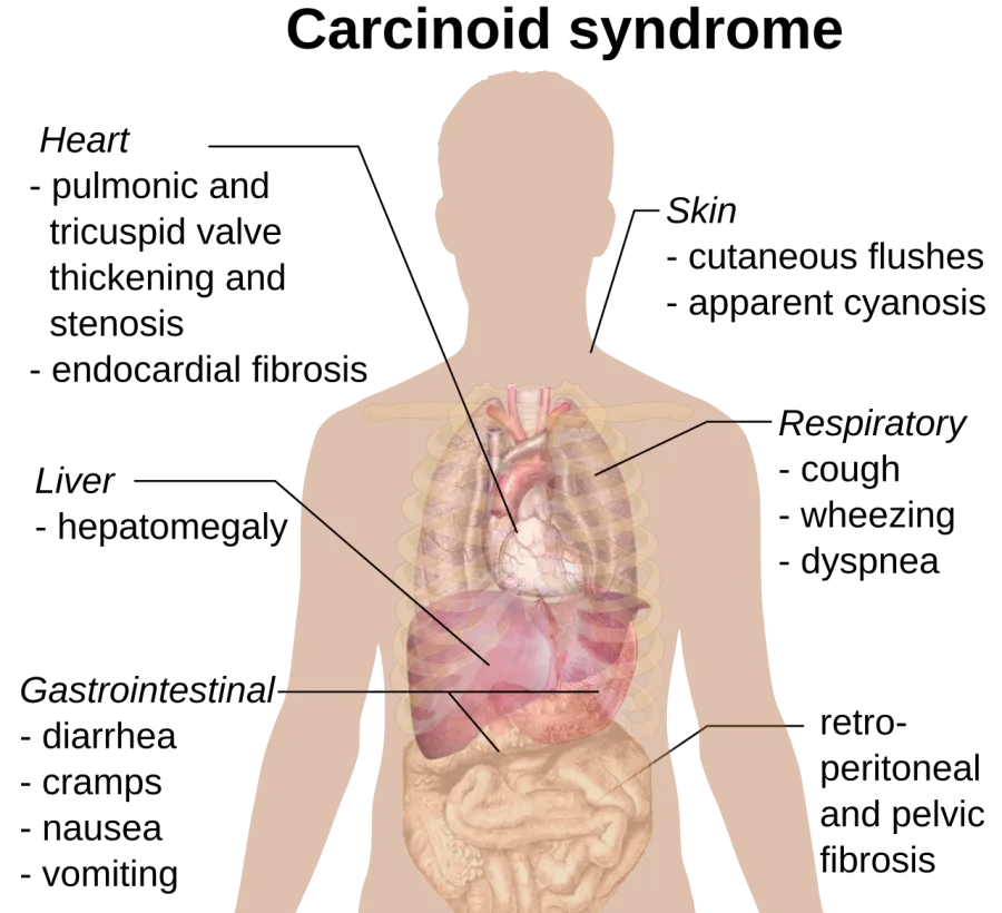 The Carcinoid syndrome card