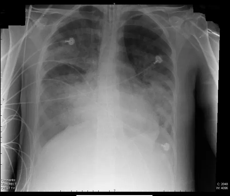 The Acute respiratory distress syndrome card