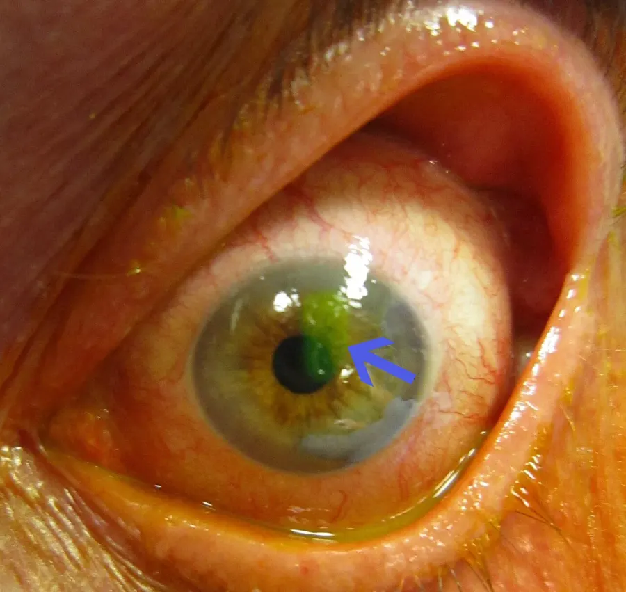 The Corneal abrasion card