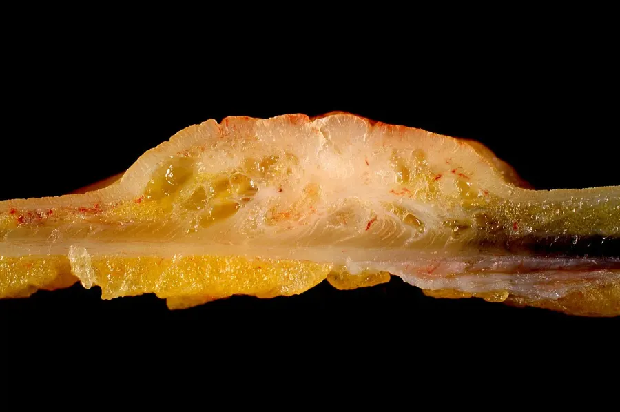 La carte Adénocarcinome