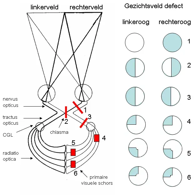 The Hemianopsia card