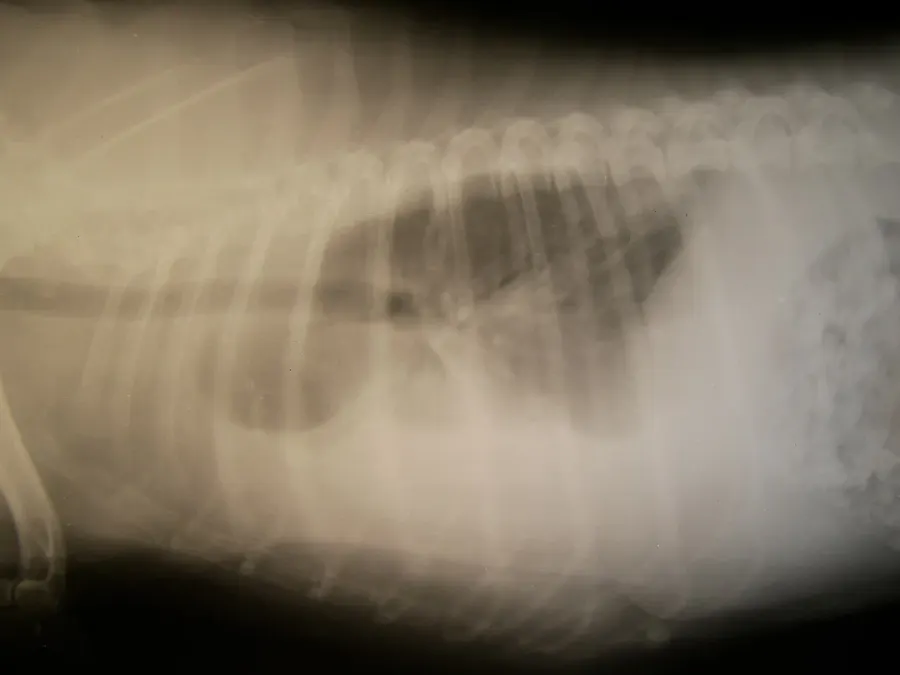 La carte Hémothorax