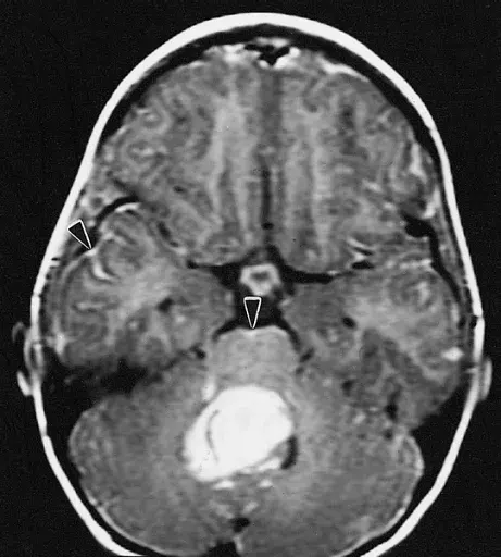La carte Neuro-oncologie