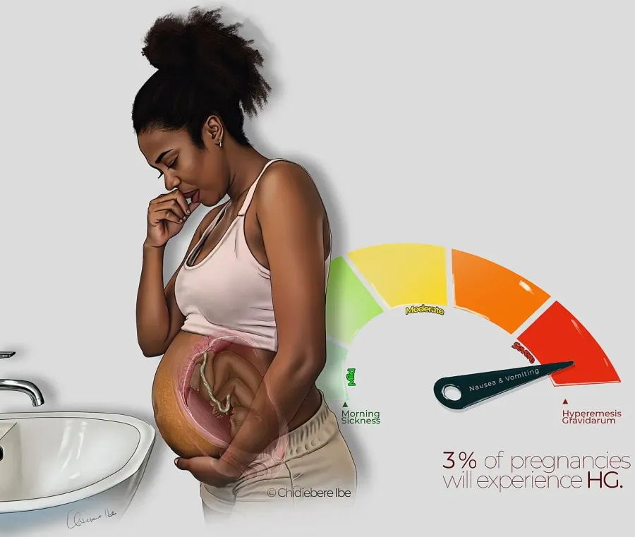 La carte Hyperemesis gravidarum