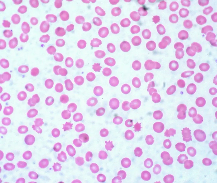 The Acanthocyte card