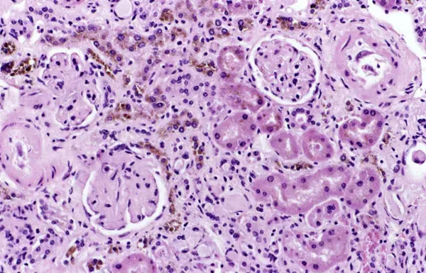 The Hemosiderin card