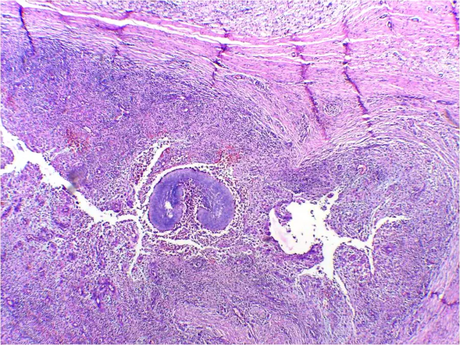 The Actinomycosis card