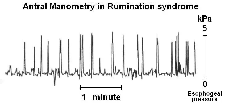 The Rumination syndrome card