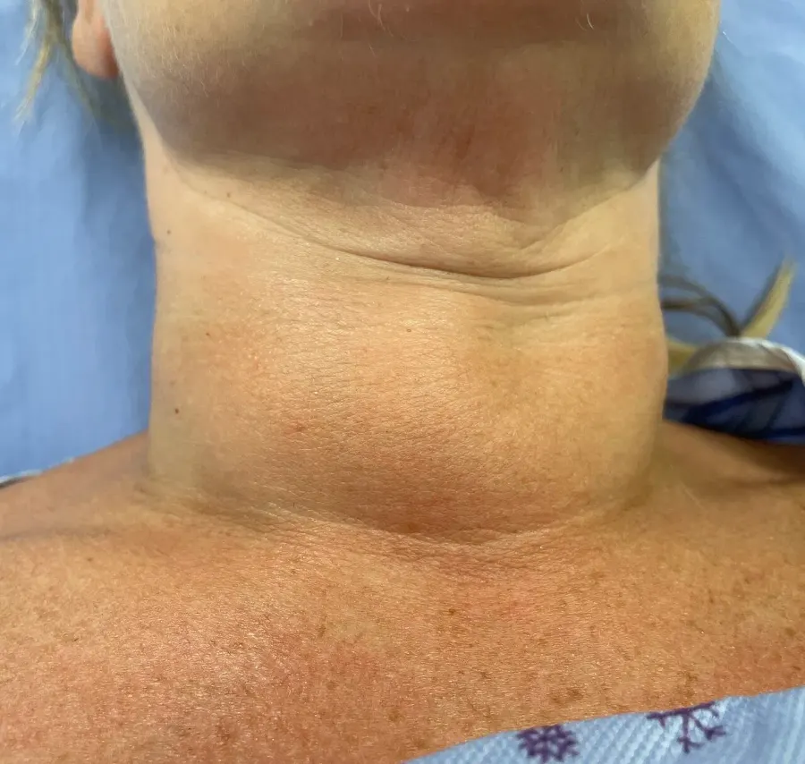 The Thyroid storm card