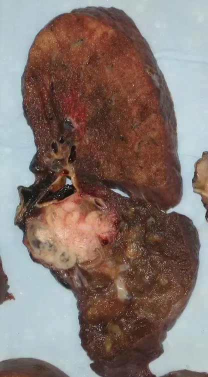 The Health effects of smoking tobacco card