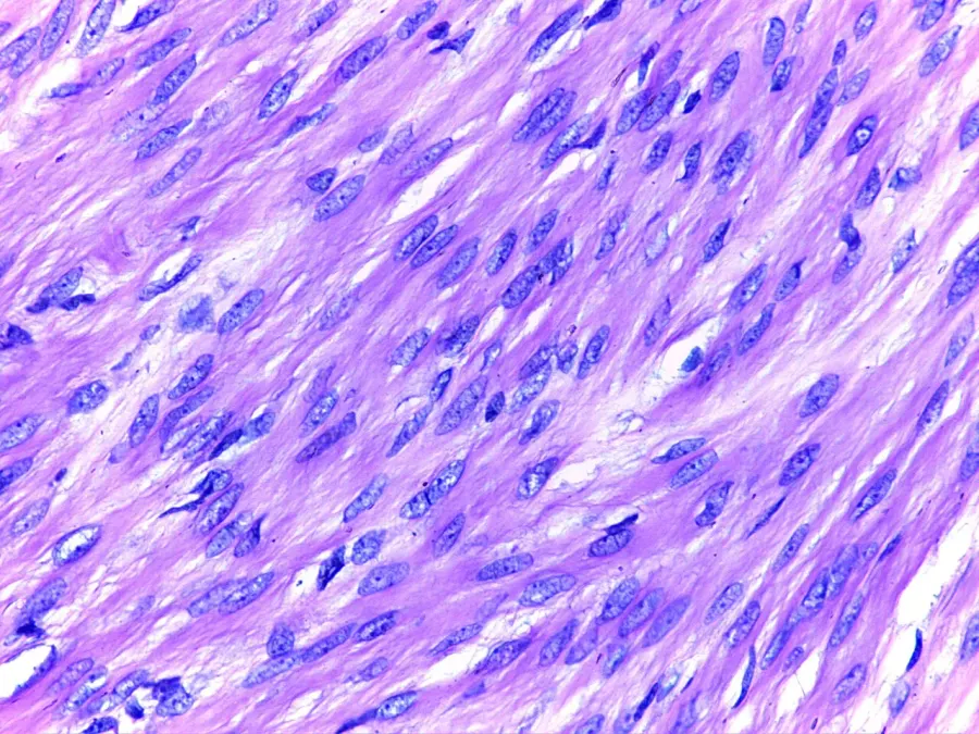 The Leiomyoma card