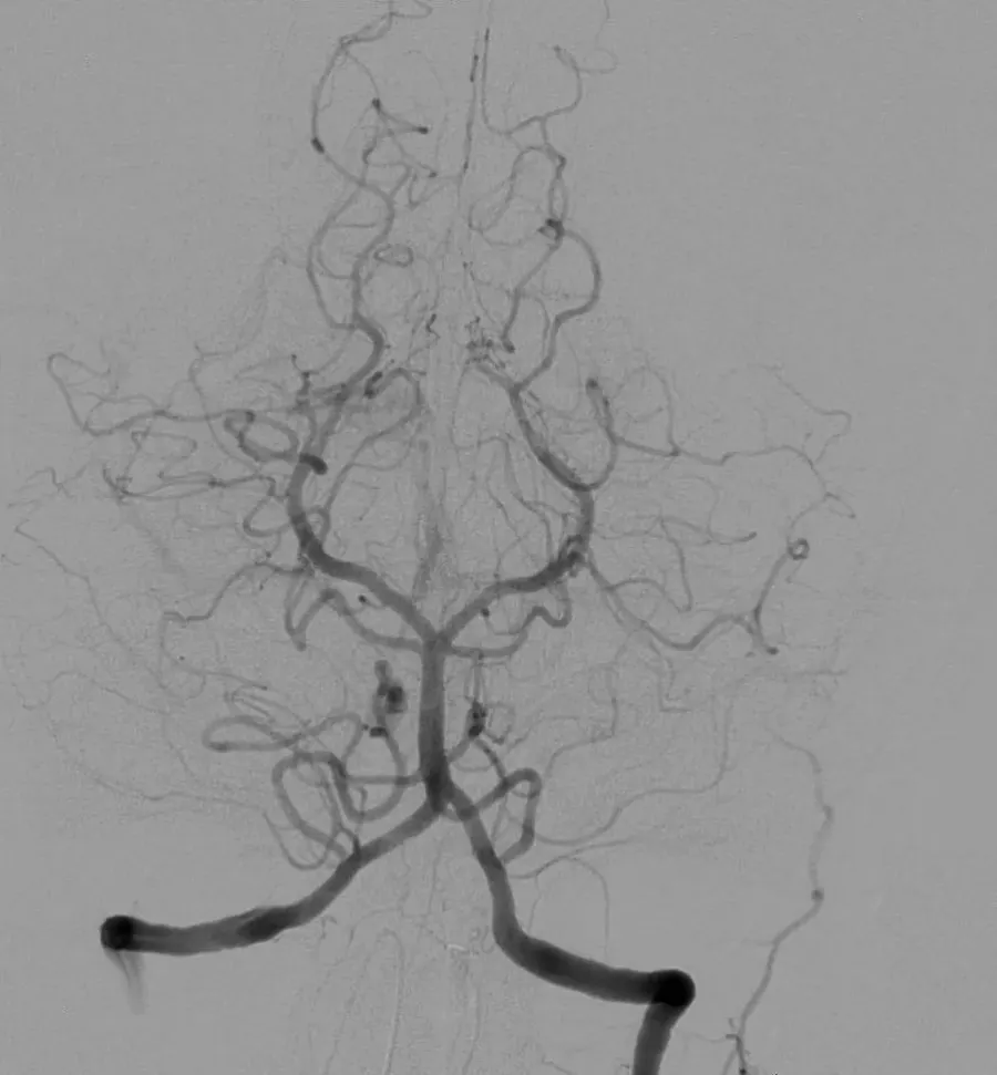 The Angiography card