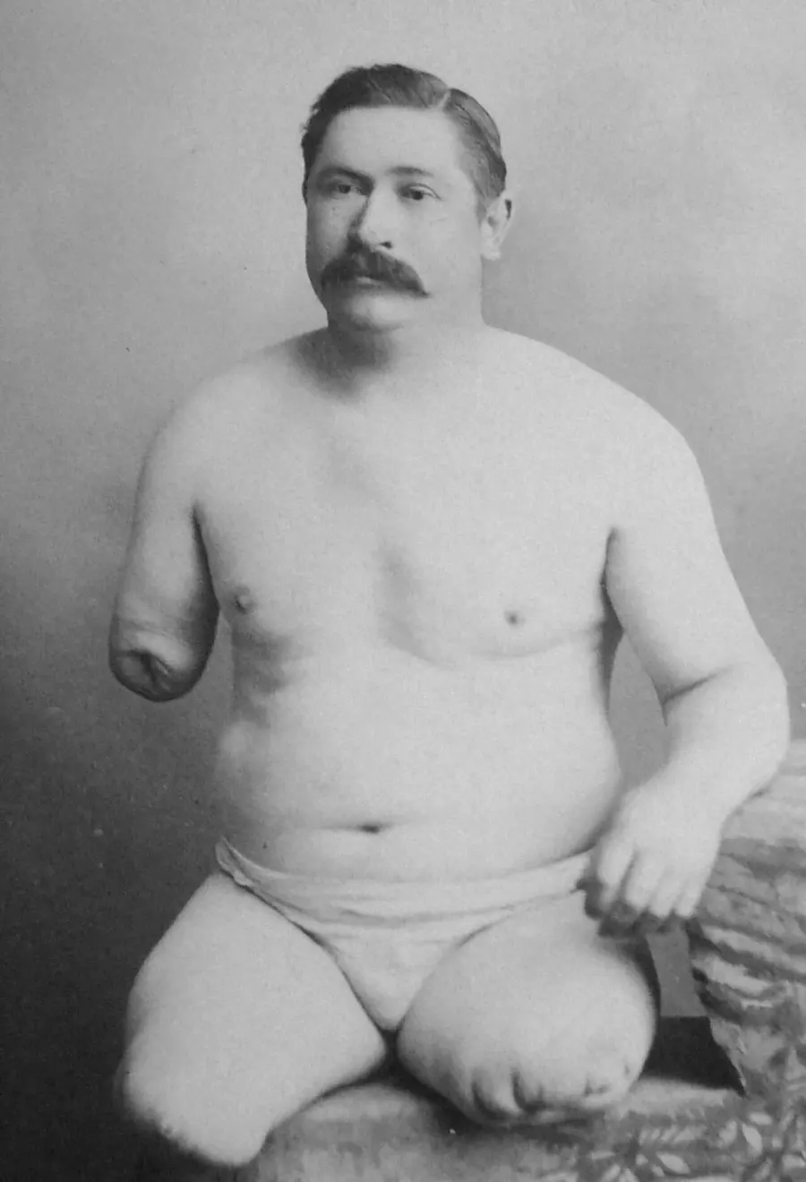 La carte Amputation