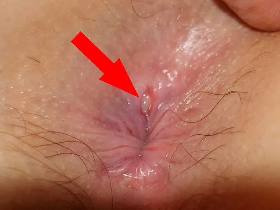 La carte Fissure anale