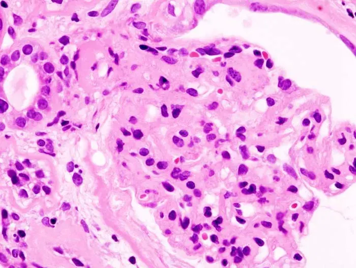 The Nephrotic syndrome card
