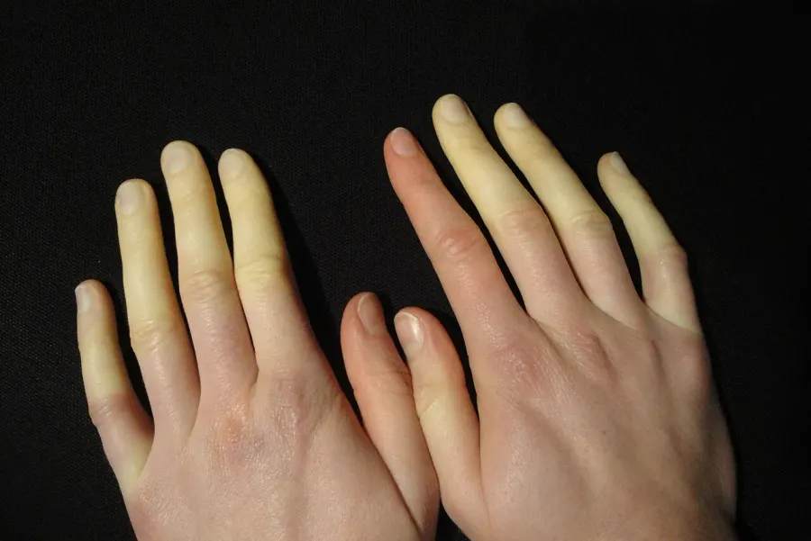 The Raynaud syndrome card