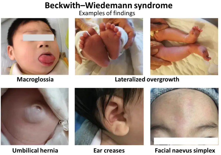 The Beckwith–Wiedemann syndrome card