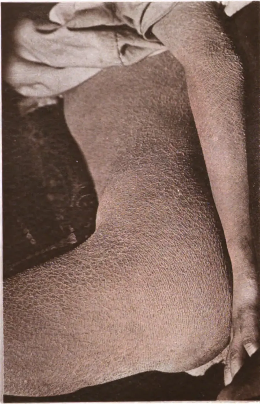 The Ichthyosis card
