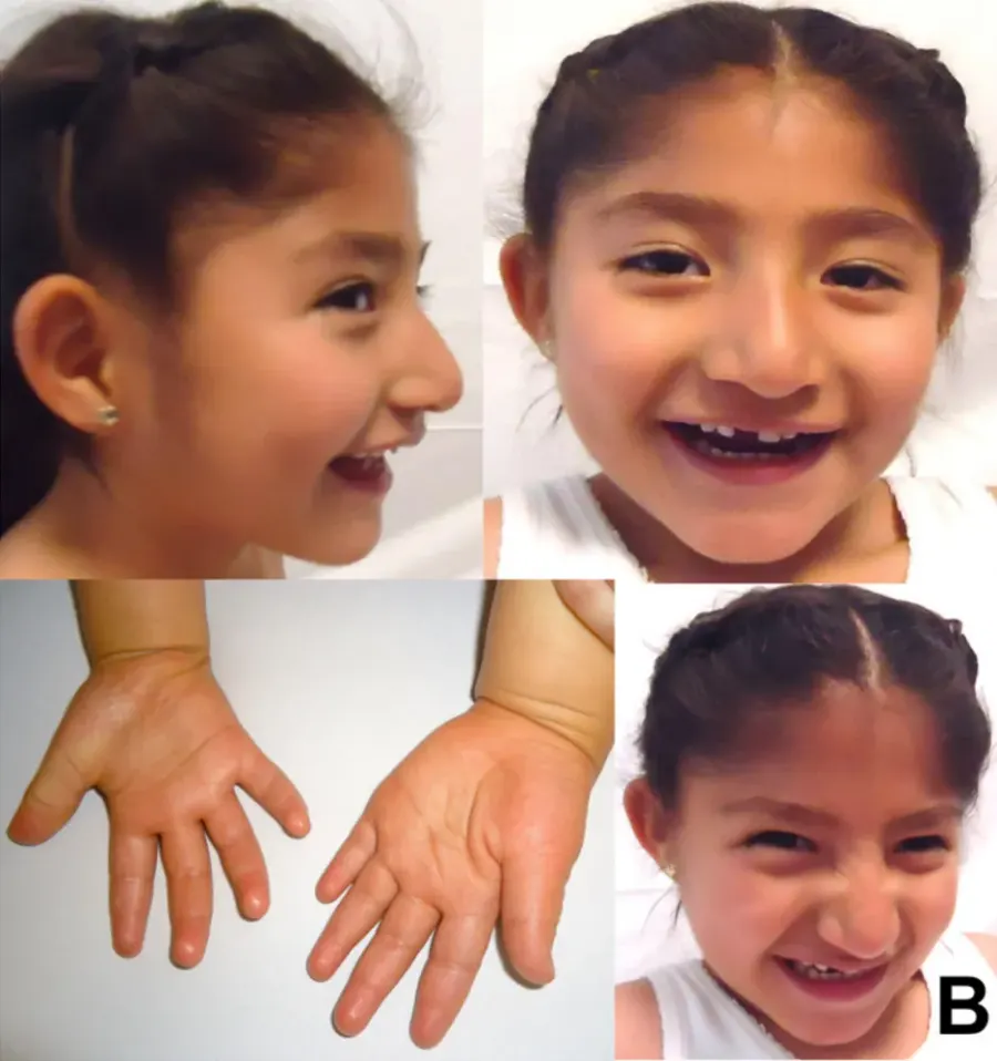 The Angelman syndrome card
