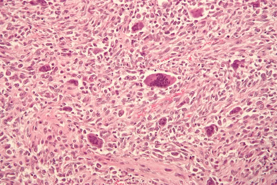 The Osteosarcoma card