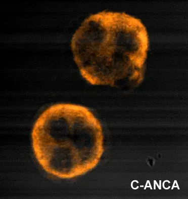 The Anti-neutrophil cytoplasmic antibody card
