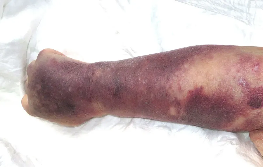 La carte Thrombopénie